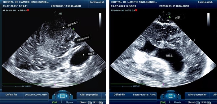 左圖顯示術(shù)中超聲見囊實性病變，大小約為4x4x3cm，病灶周圍腦組織水腫明顯；右圖為病灶切除后，術(shù)中超聲示術(shù)腔無病變殘留