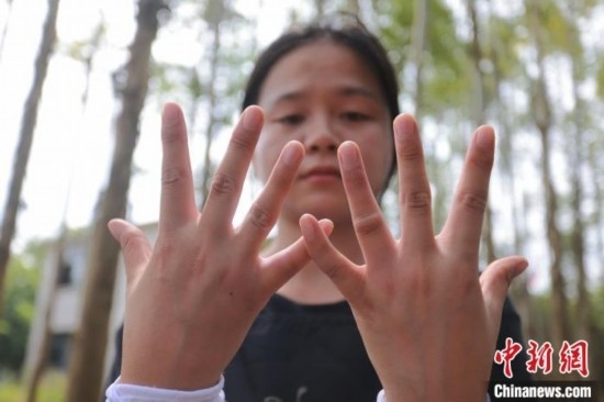 吳素英展示被蜜蜂蜇過的雙手。湯曉逵 攝