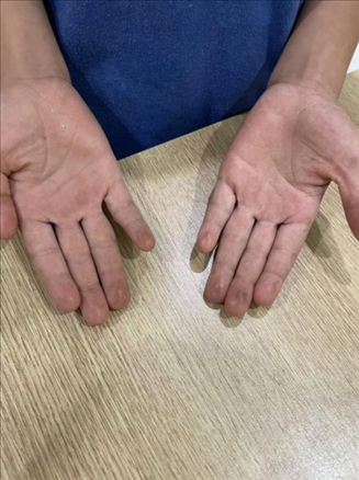 9歲小學生長期拍煙卡，手部粗糙長繭。受訪者供圖